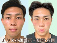 ナチュラルビューティーフェイス 横浜(NBF)/メンズ小顔矯正/顎の歪み/横浜駅