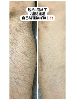 リル(Lil)/足脱毛3回目終了後2週間経過☆