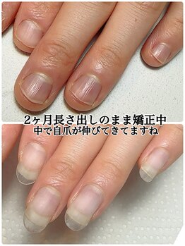 スマイルニコ(smile nico)/深爪矯正長さ出しできます