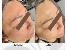 アン ビューティー(ann beauty)/施術1回【症例写真】50代女性