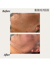 クロッシュ(Cloche)/光脱毛　ひげ３箇所