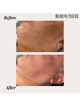 クロッシュ(Cloche)/光脱毛　ひげ３箇所