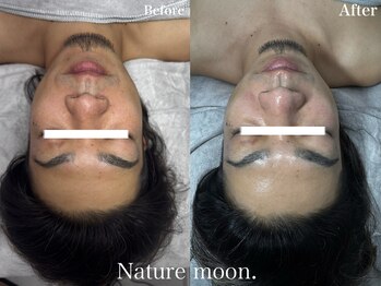 ナチュールムーン(Nature moon.)/ハーブピーリング