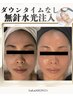 No.1【速攻性◎ツヤ肌♪】無針水光注入+水素毛穴洗浄本格肌改善プログラム