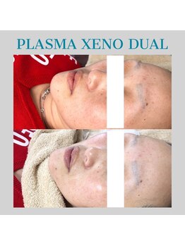 ビーダブリュー(BW...)/☆プラズマゼノデュアル施術例☆