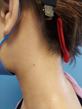 キアラ 麻布十番(Kiara)/えりあし脱毛