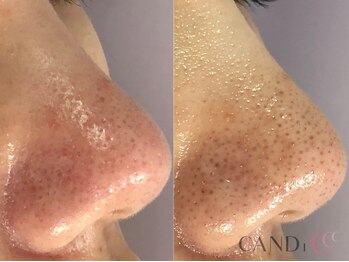 キャンディ 栄店(CANDi)/ハイドラピーリング/黒ずみ毛穴