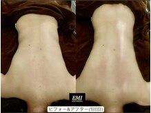 EMI 上野店/#ボディラインを整えたい
