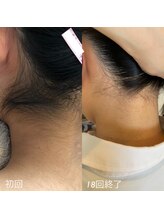 グレーシス(Graces)/学生さま【全身18回脱毛ご卒業】