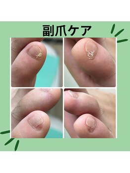巻き爪補正店 徳重店/副爪ケア