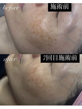 ベイビースキン(Baby skin)/シミケア Before→After