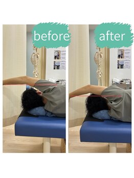 志村三丁目駅前鍼灸院 接骨院/肩甲骨の施術後