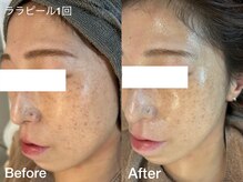 プティ 横浜店(Petit)/ララピールで肌管理！