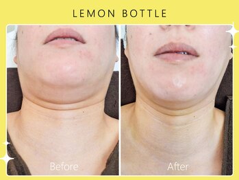 ハノハノ 八代店(HANO HANO)/【八代初導入！】レモンボトル☆