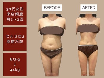 ベベティー(BEBETIE)の写真/【無料カウンセリング月5名限定☆】必要な施術を正しく受けることで最速で大幅なサイズダウンも可能！