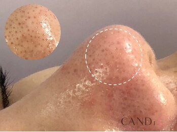 キャンディ 栄店(CANDi)/ハイドラピーリング/黒ずみ毛穴