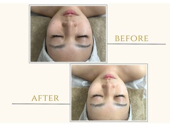 セン(Sen)/ビフォーアフター