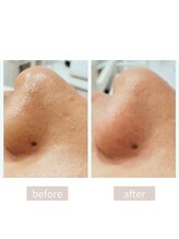 ムー(MUU)/《毛穴洗浄before＆after》