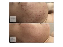 ベルティーク(BELTHEQUE)/ニキビケア