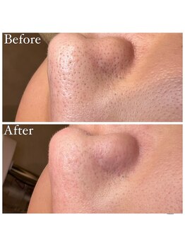 マドモアゼル 麻布十番/毛穴洗浄