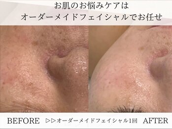 サロンド ソラ(Salon de SoLA)/毛穴の黒ずみトラブル