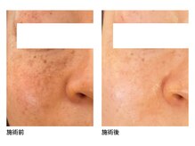 オーシャンブルー 長崎店(OCEAN BLUE)/美白・シミケア