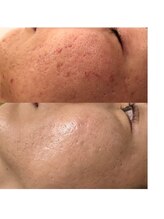 ココ 2号店(CoCo)/ハーブピーリング/凸凹改善