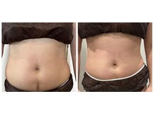 当店自慢のオーダーメイド痩身×トレーニングで理想の身体へ♪