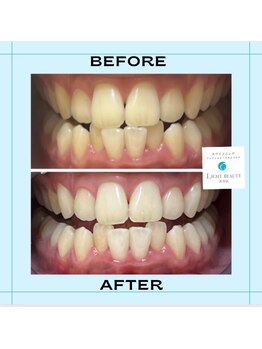 ライトビューティ 渋谷本店(Light Beauty)/セルフホワイトニング