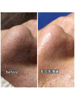 メンズガーデン(men's Garden)/頑固なアゴヒゲ脱毛も