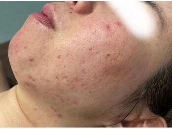 アンドユー ヨコハマ(&U Yokohama)/クリスティーナ施術前