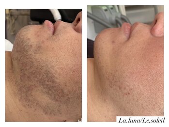 ラ ルーナ ル ソレイユ(La.luna Le.soleil)/メンズヒゲ脱毛