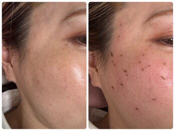 ルル(RuRu)/シミケア