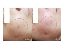 モニ 福岡(Moni)/ハーブピーリング で シミケア