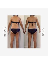 ラグレ(LUXRE)/脂肪冷却モニター（40代）