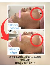 クローバー(clover)/ハリ感♪シワ改善