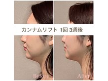 キラビューティー 二子玉川店(KIRA Beauty)の雰囲気（最新カンナムリフト　1回　B/A　20代）