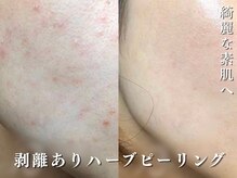 ダリア(Dahlia)/細かいプツプツニキビにも