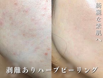 ダリア(Dahlia)/細かいプツプツニキビにも