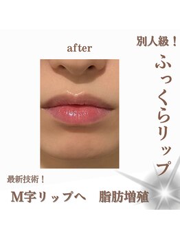 クリニカルボーテ 心斎橋院(CLINICAL BEAUTE)/ぷるっと！可愛い唇造形！