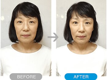 ワト(WATO)/■小顔施術(before→after)