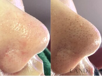 キャンディ 栄店(CANDi)/ハイドラピーリング/黒ずみ毛穴