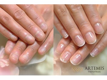 アルテミス(ARTEMIS)/深爪育成コース