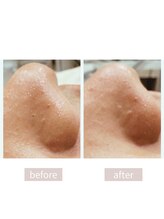 ムー(MUU)/《毛穴洗浄before＆after》