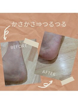 カルーナ(Calluna)/かかとしっとり♪カサカサの緩和