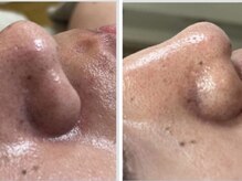 エビスラボ(Ebisu Labo)/毛穴テカリケア