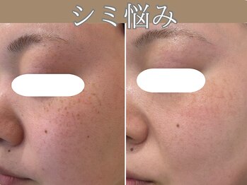 ハウオリ(HAUOLI)/シミ改善