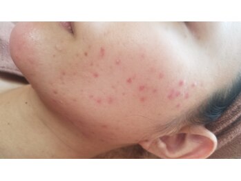 プラーベートサロン エクラ(eclat)/ハーブピーリング