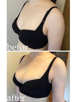美人バスト 町田店/バストアップ◇症例◇