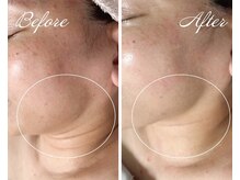 AK エステティックス(AK Esthetics)/シュっとした輪郭に★小顔ケア